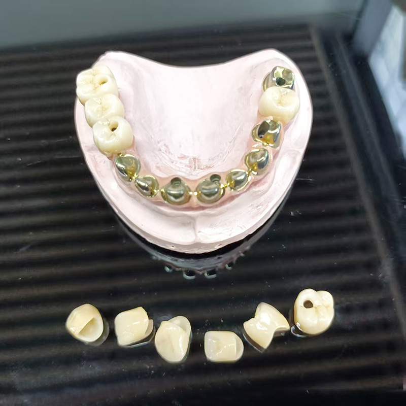 Jembatan Keramik Logam Lengkung Penuh (Prosthesis Lengkung Penuh PFM)